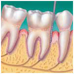 Entzündung des Zahnhalteapparates (Parodontitis)